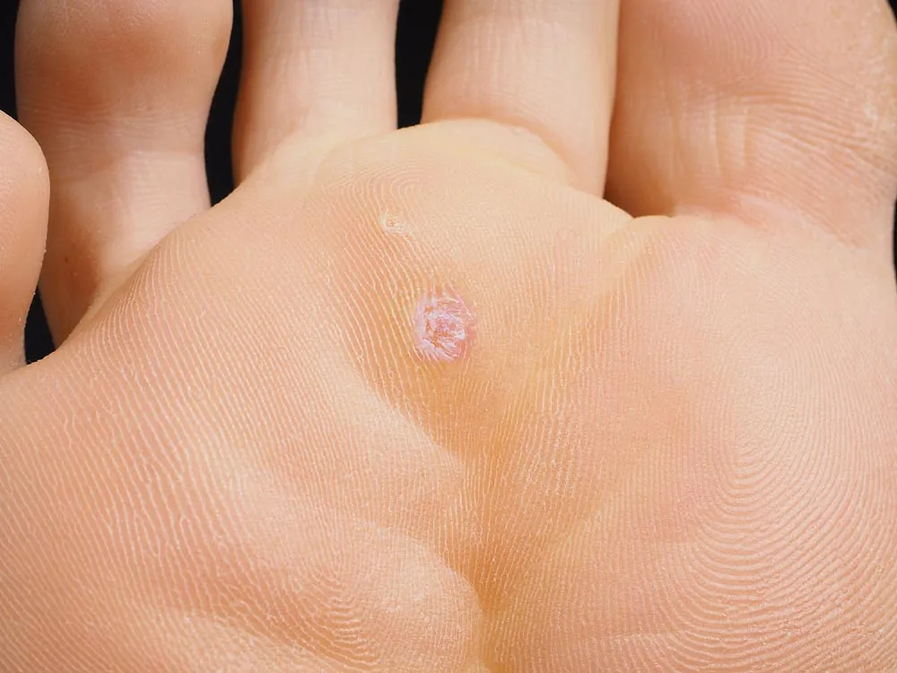 parte de un pie con un grano